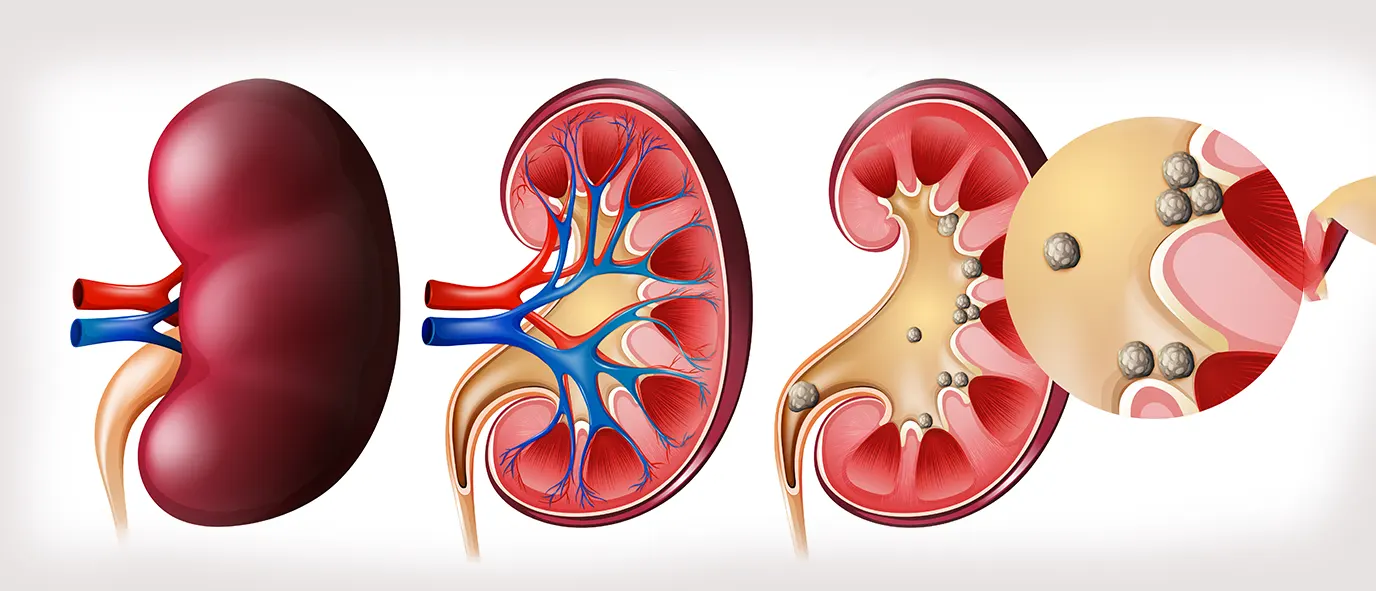 Urological Stone Diseases