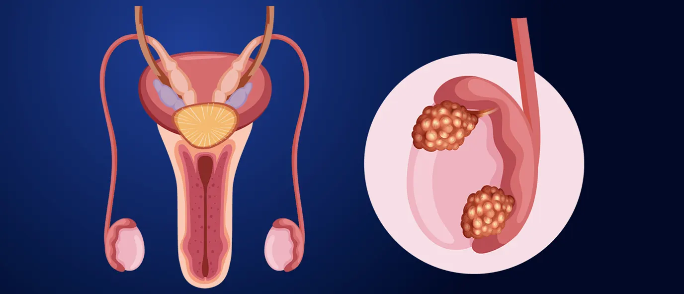 Testis Kanseri