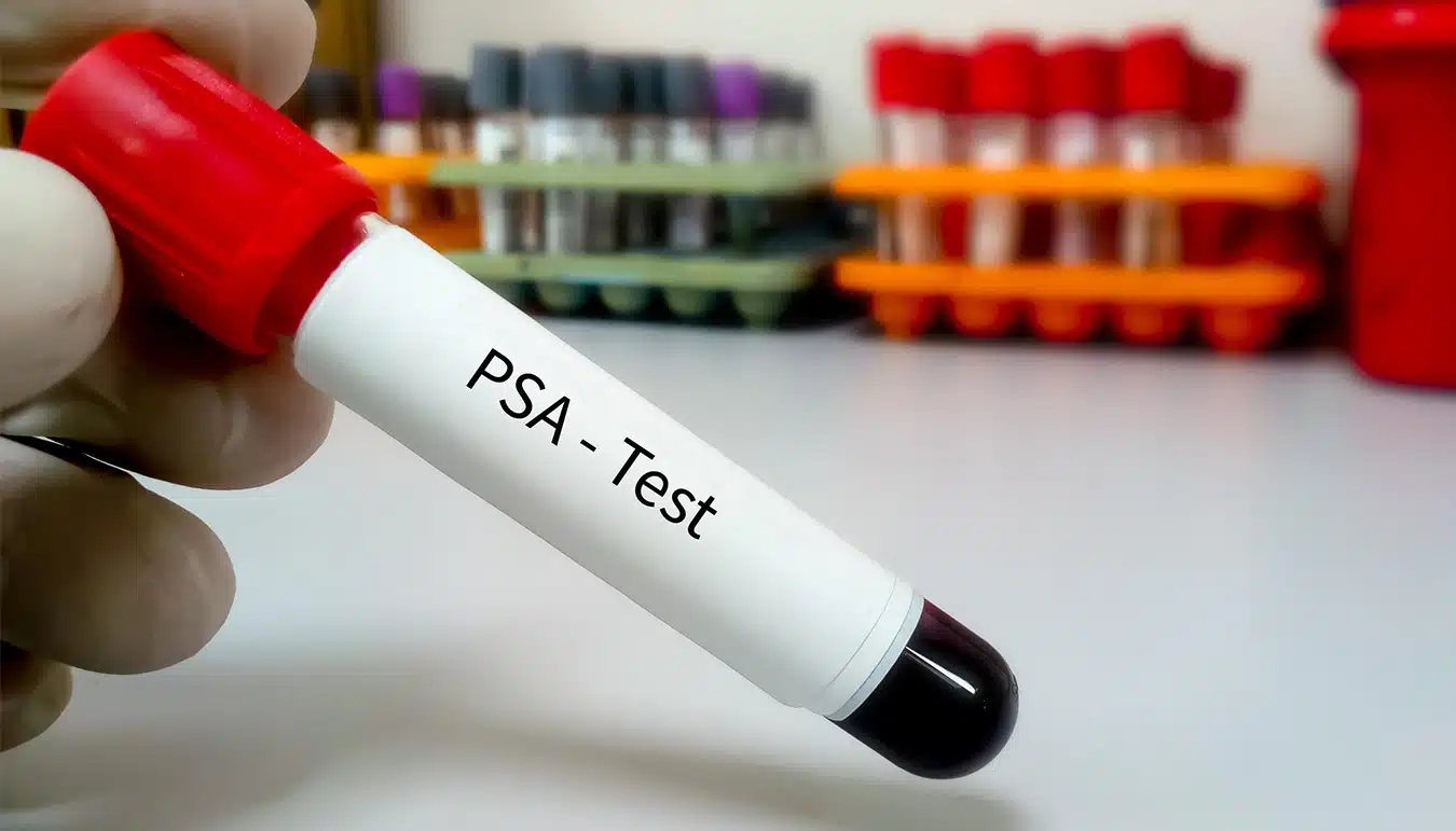 What is PSA Test? | Prof. M. D. Hasan Biri | Urologist